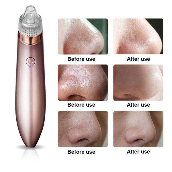 Electric Blackhead Vacuum Cleaner Pore Cleaner Acne Remover